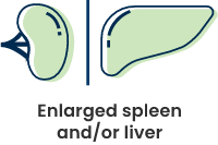 Spleen and liver icons with text stating enlarged spleen and/or liver